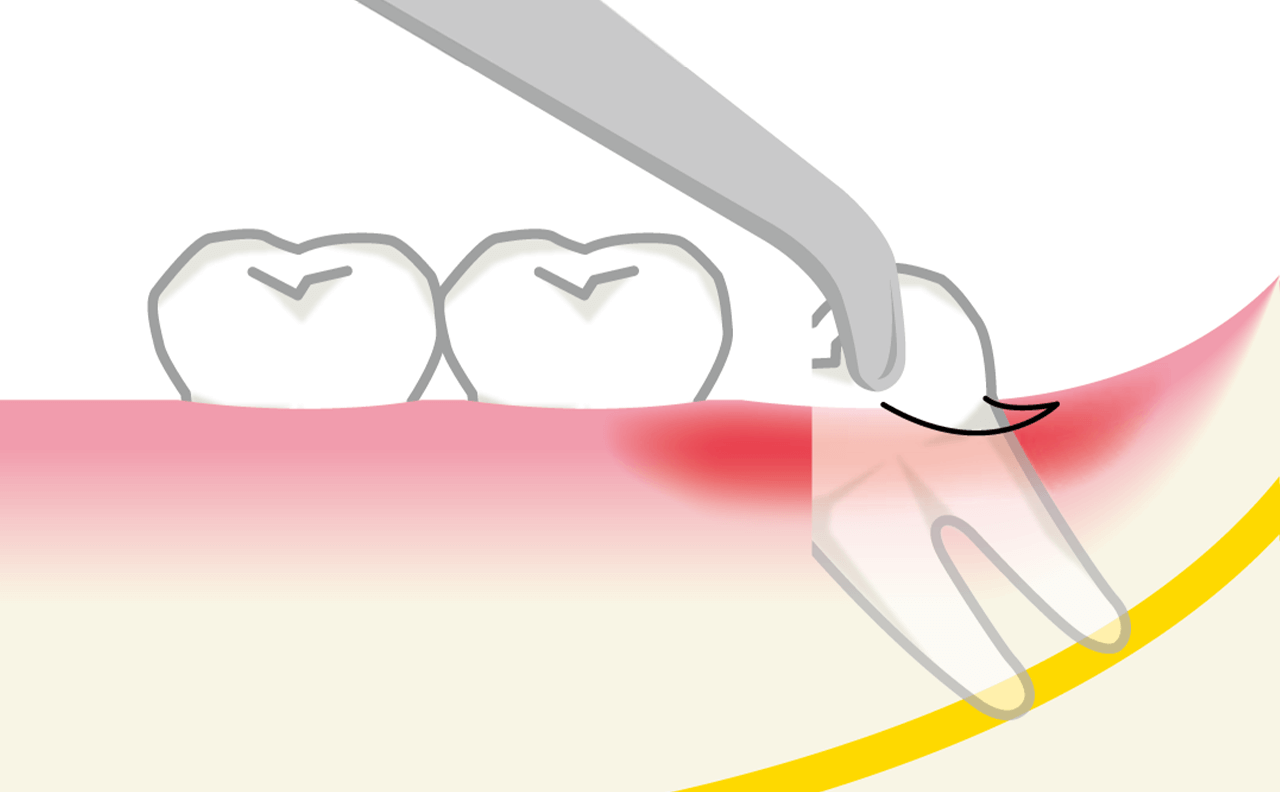 抜歯の流れ（一例）抜歯後の治癒過程アクセス